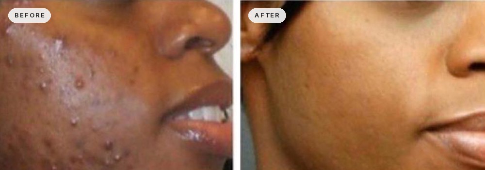 Acne Scar Removal 18