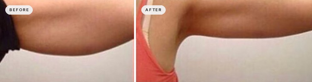 Non Surgical Arm Lift 04