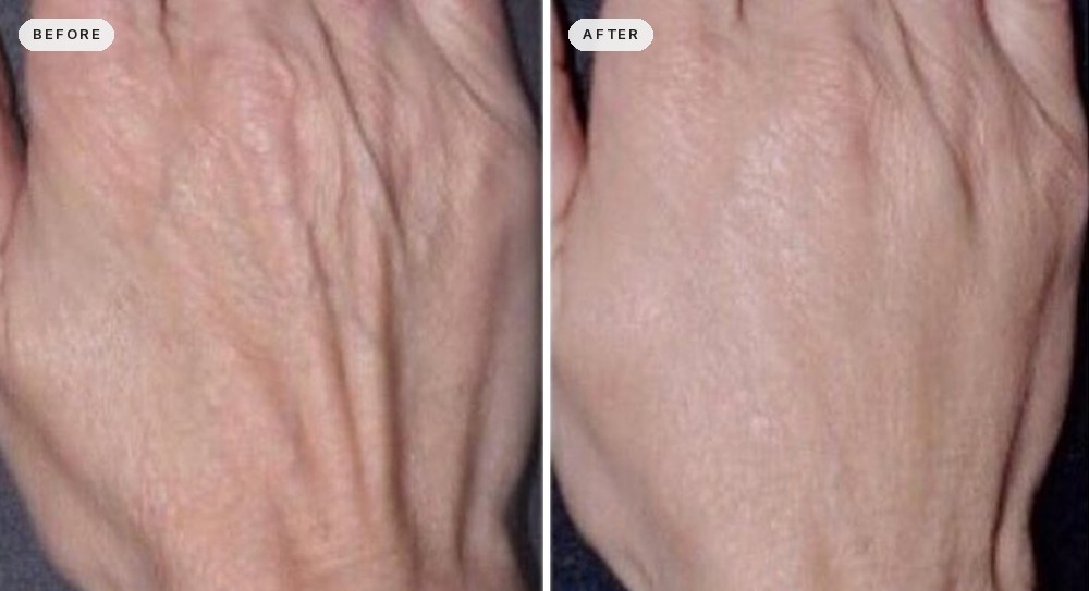Hand Rejuvenation 07