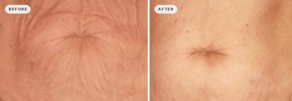Skin Tightening 09