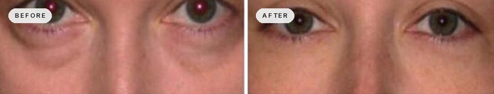 Dark Circles & Eye Bags 45