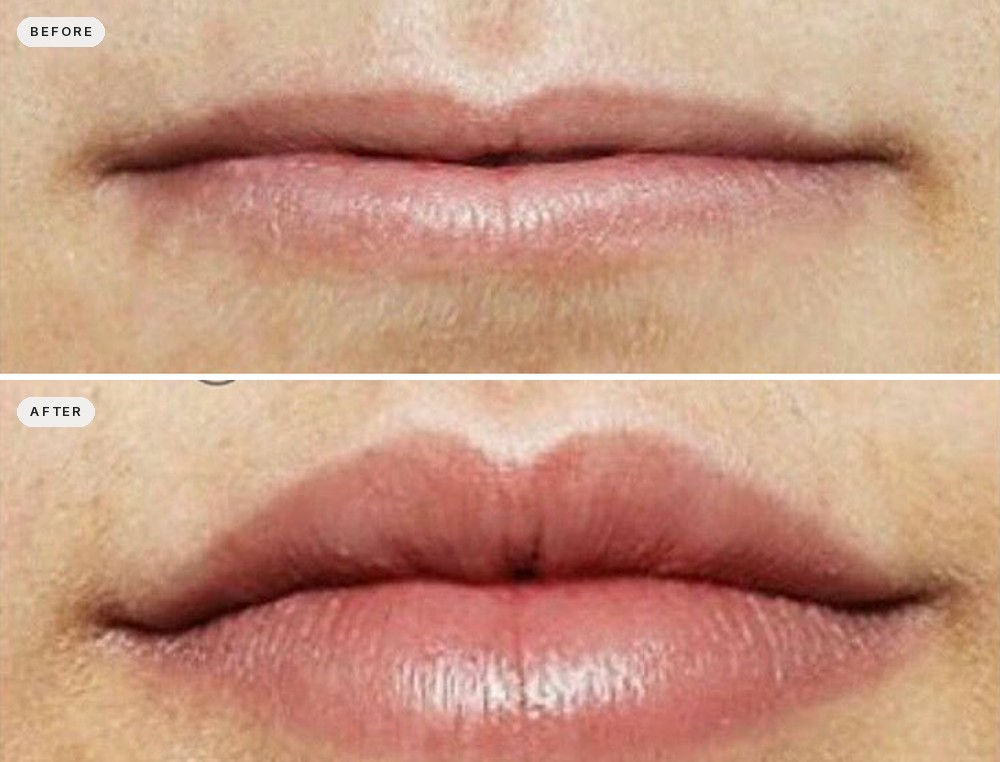 Lip Augmentation 31