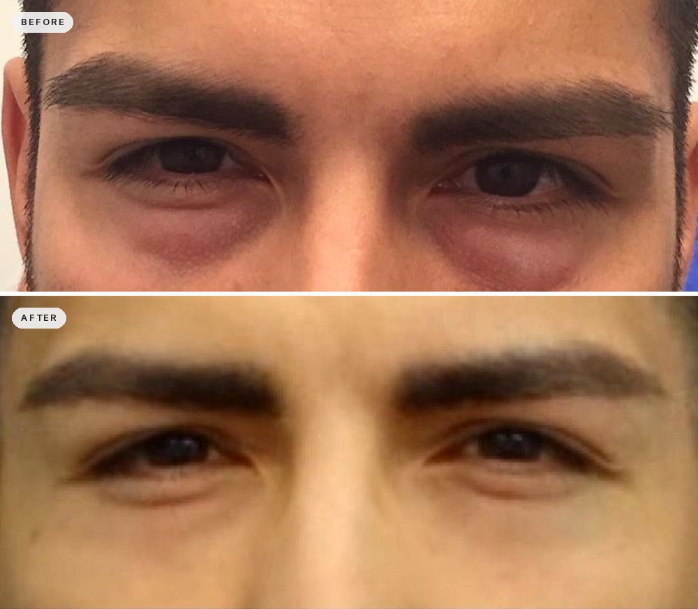 Dark Circles & Eye Bags 50