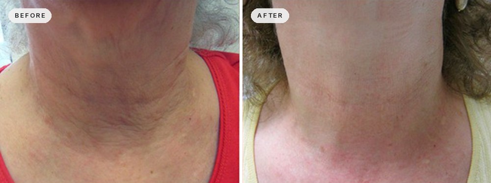 Non Surgical Neck Lift 24