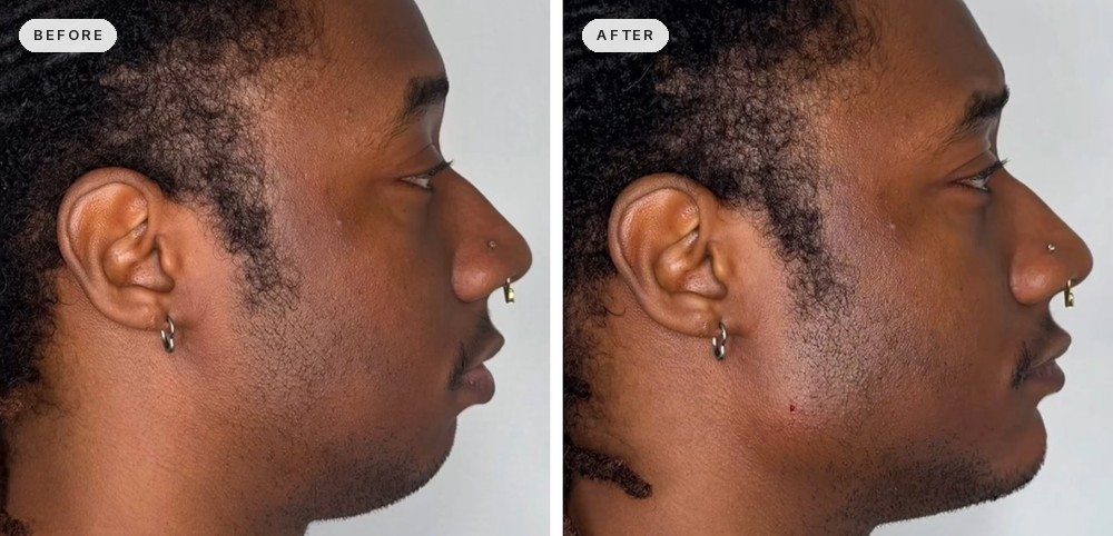 Jawline Contouring 41
