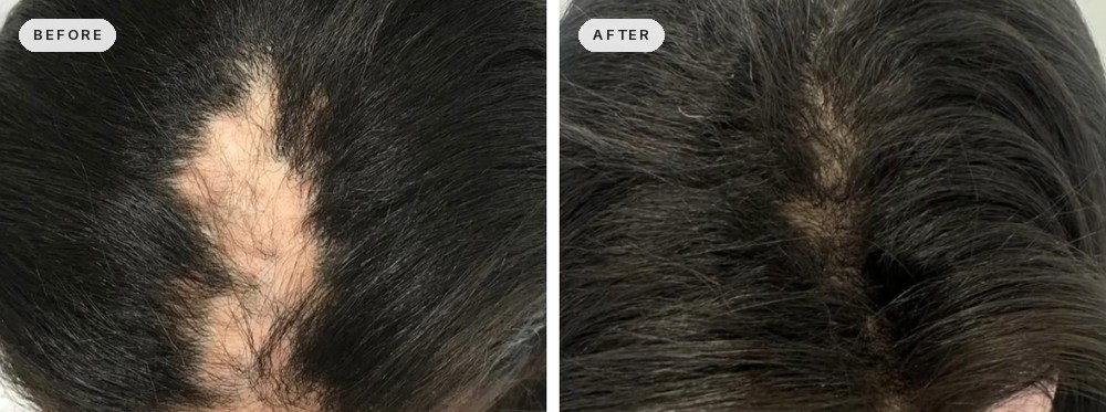 Hair Restoration 05