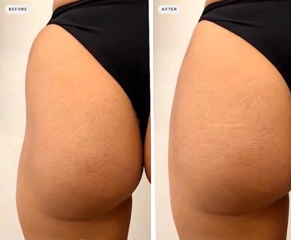 Brazilian Butt Lift 33