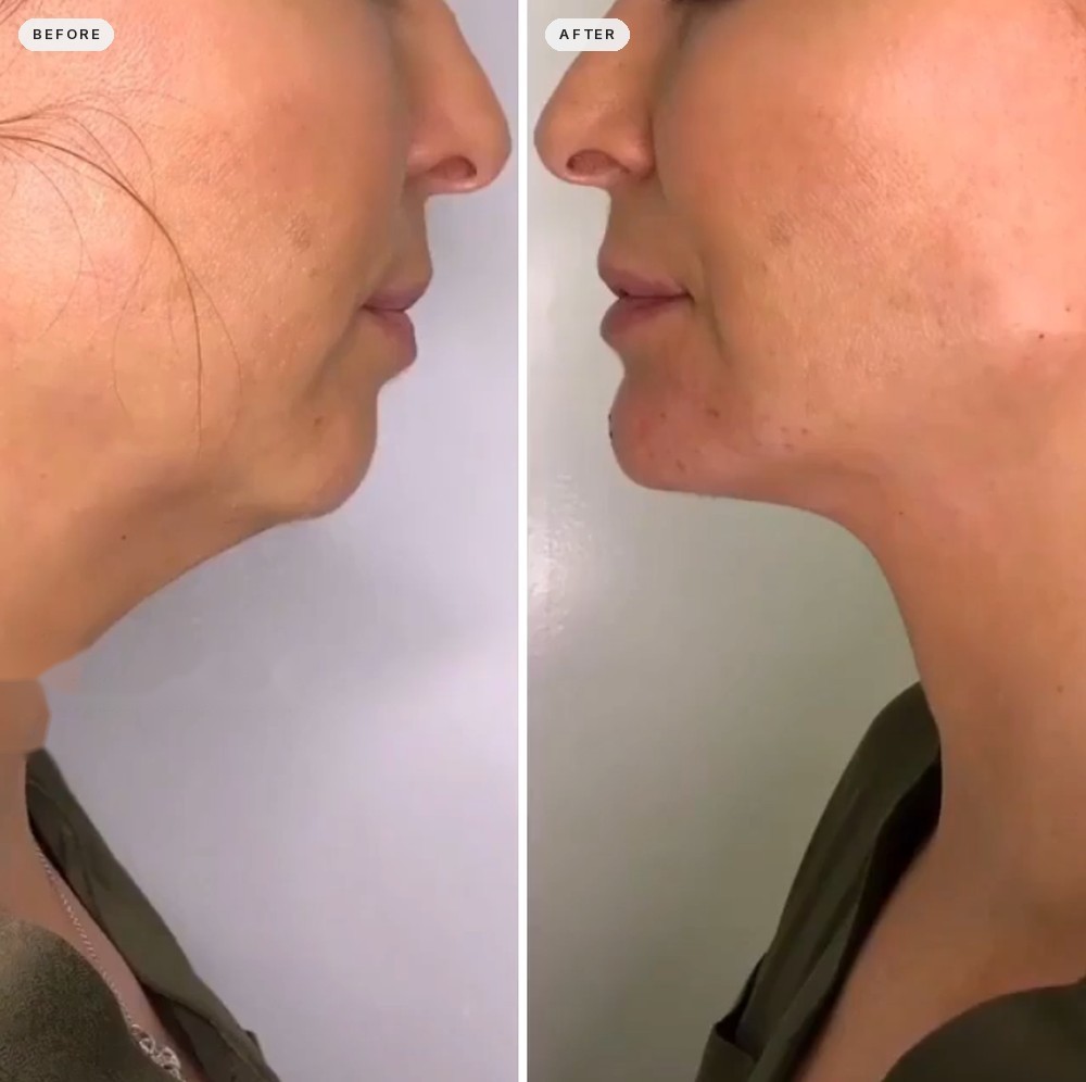 Jawline Contouring 44