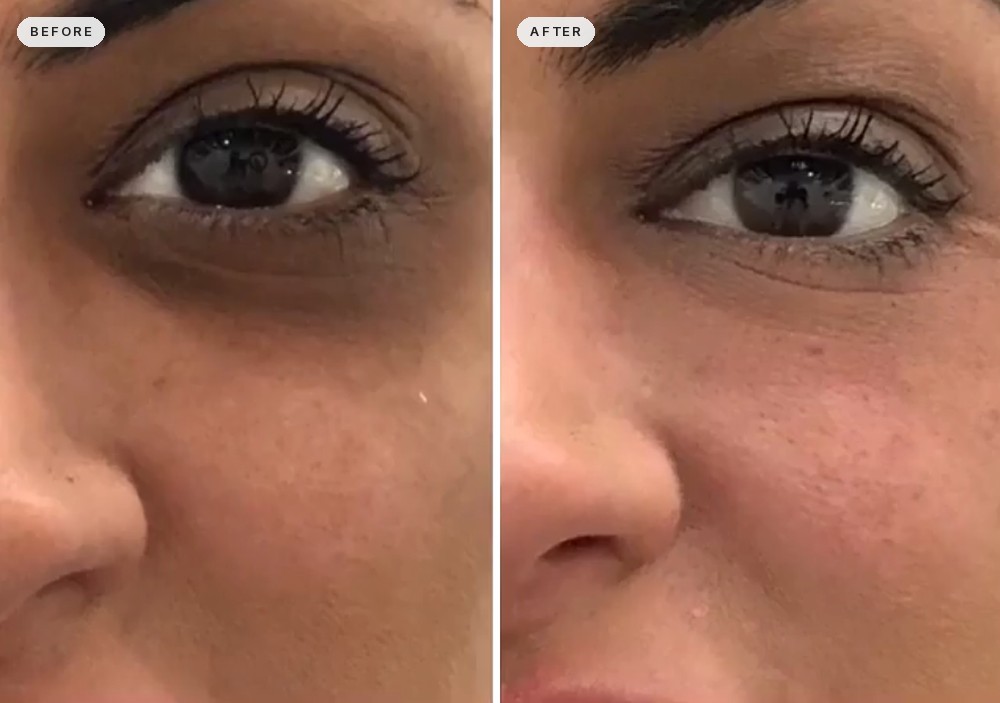 Dark Circles & Eye Bags 58