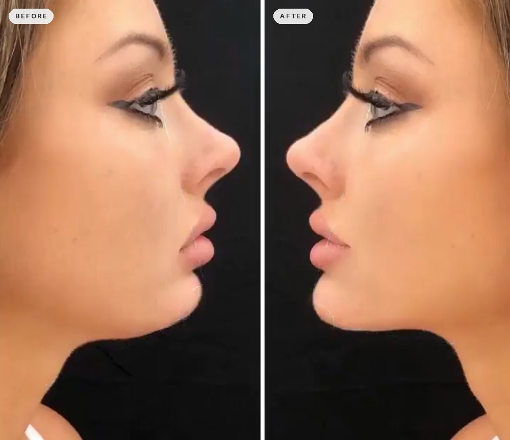 Jawline Contouring 47