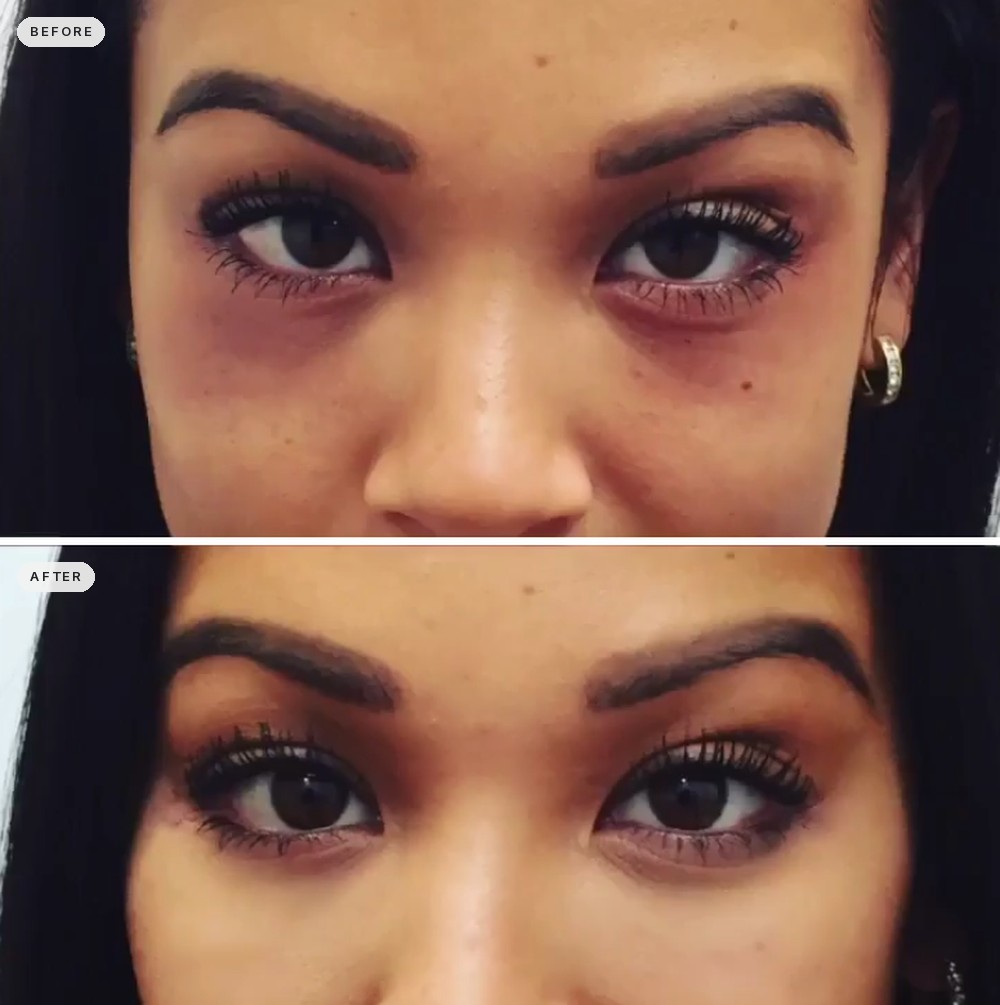 Dark Circles & Eye Bags 59