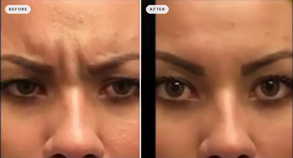Wrinkle Removal 21