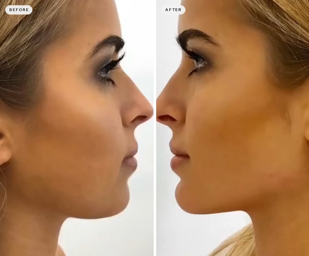 Jawline Contouring 53