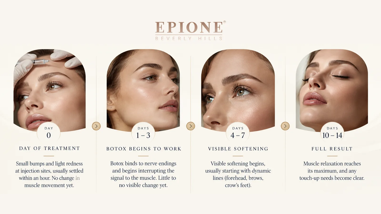 Day 0 to day 14 timeline showing how long does Botox take to work after treatment