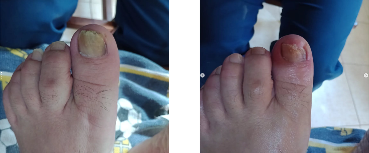 Antes y después de cuidado profesional del pie