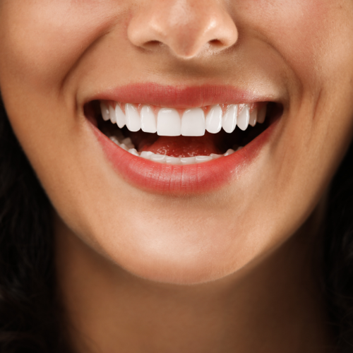 Dental veneers Las Vegas - porcelain smile transformation