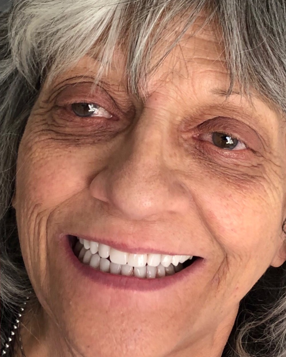 After dental implants at Sahara Dental in Las Vegas