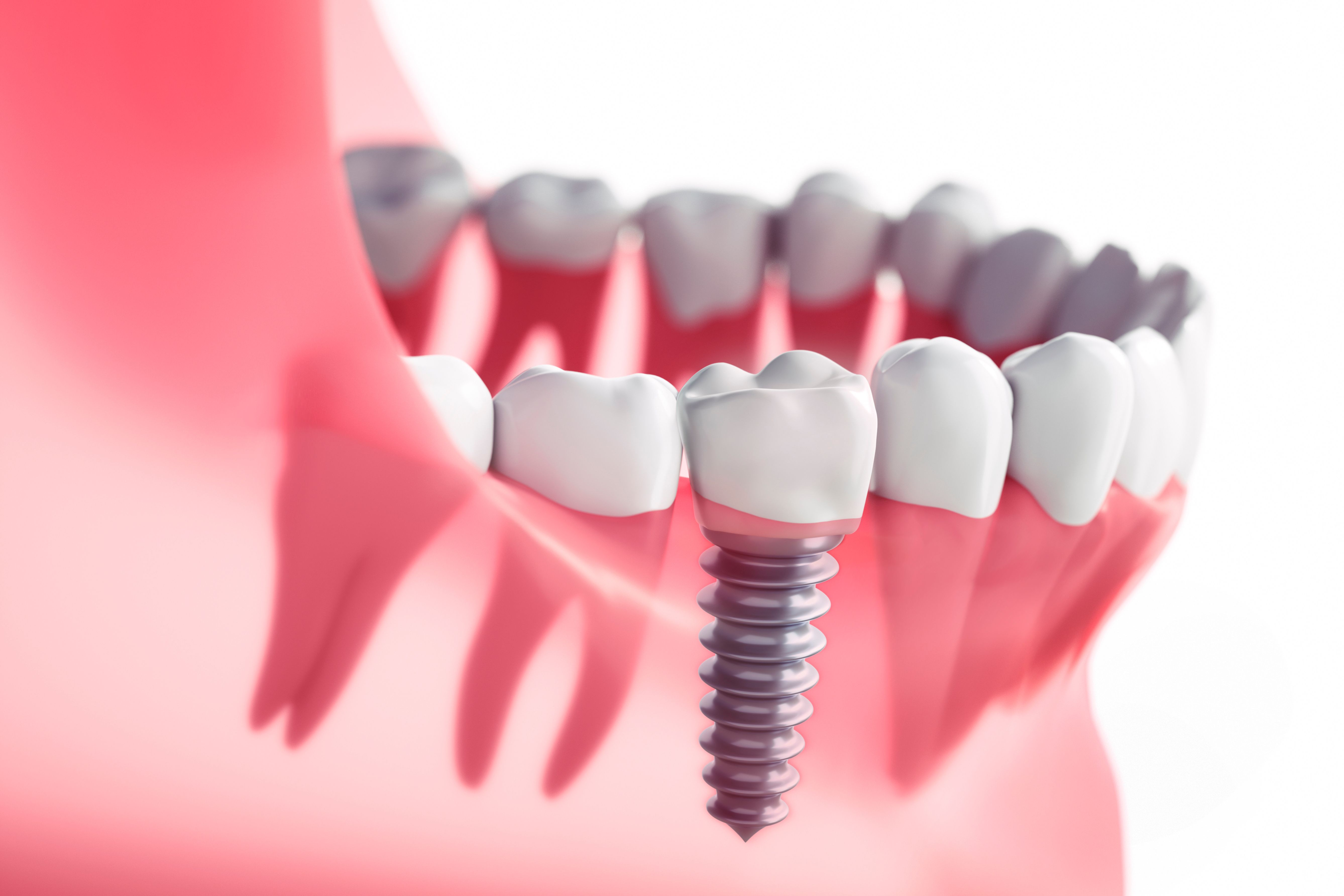 Close-up of a bright, healthy smile, dental implant cost guide from Sahara Dental Center in Las Vegas