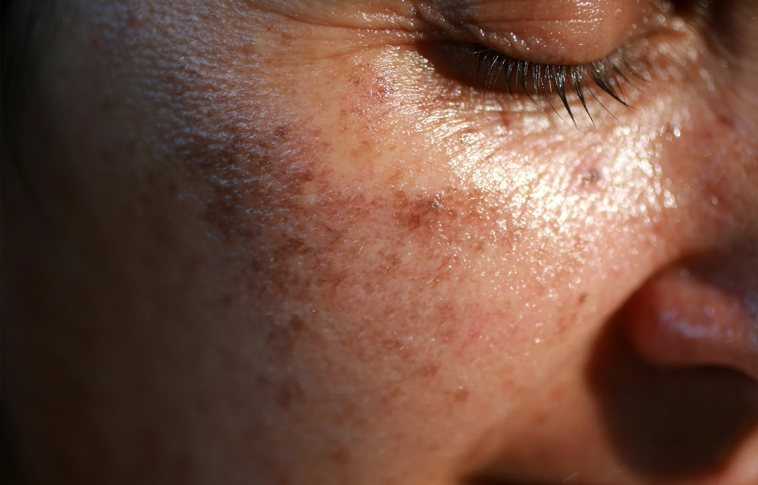 A close up of a person with sun spots on their face.