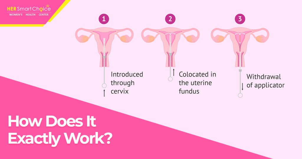 how IUDs work
