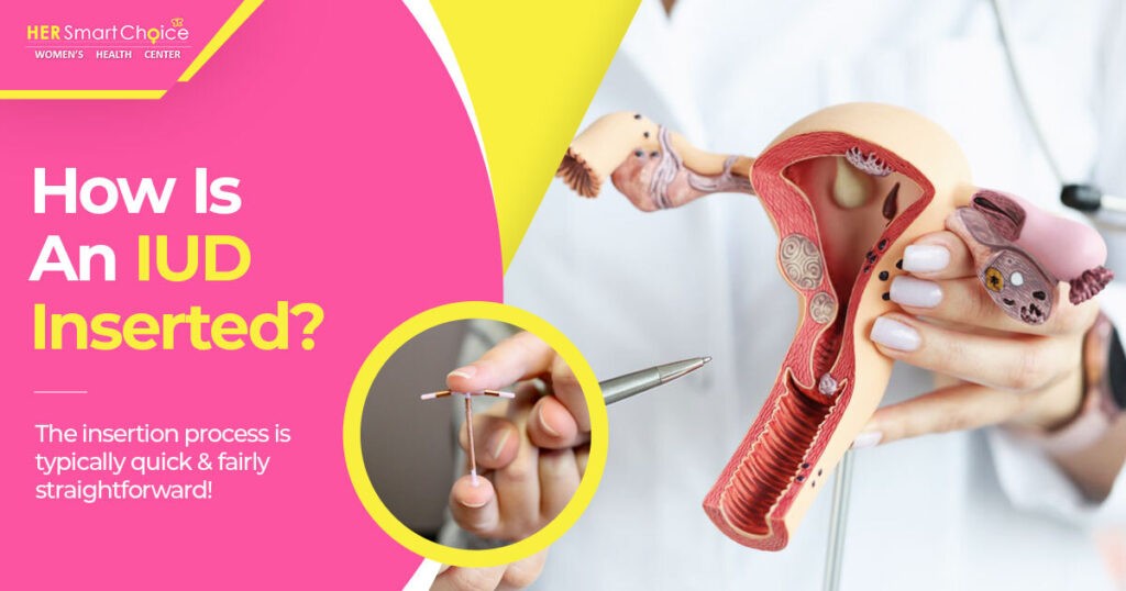 How IUD is inserted