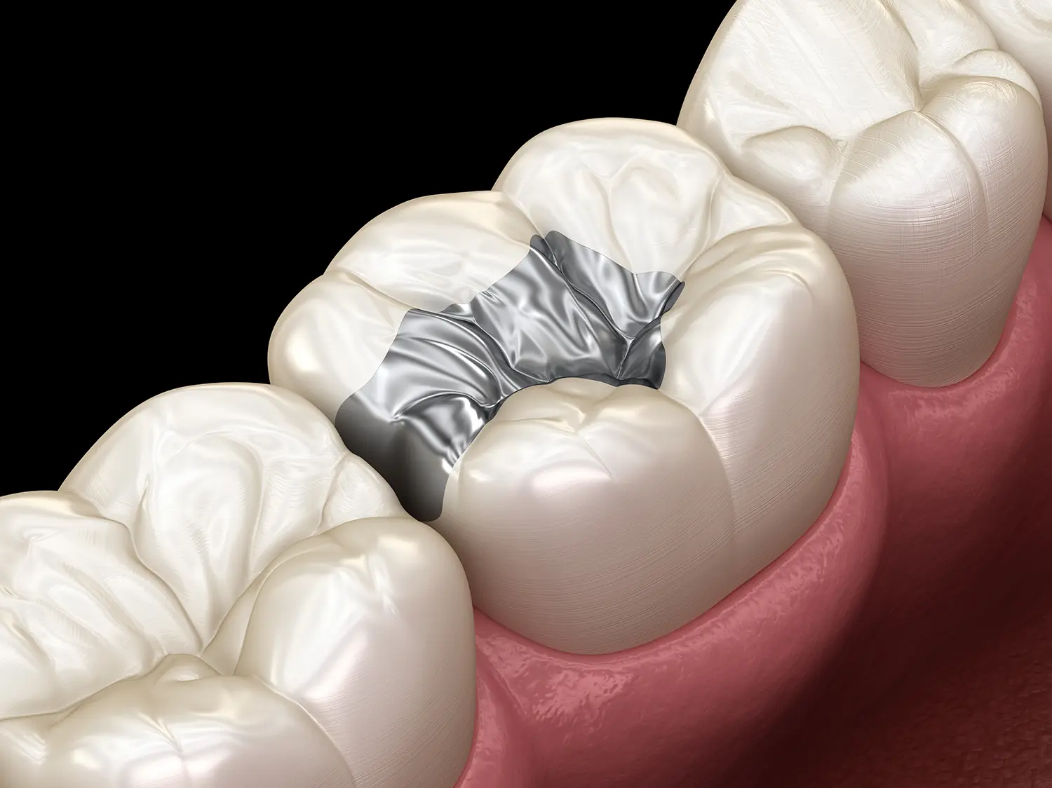 Mercury-Free Dentistry in Gulf Breeze, FL | Pearl and Pine Dental Studio