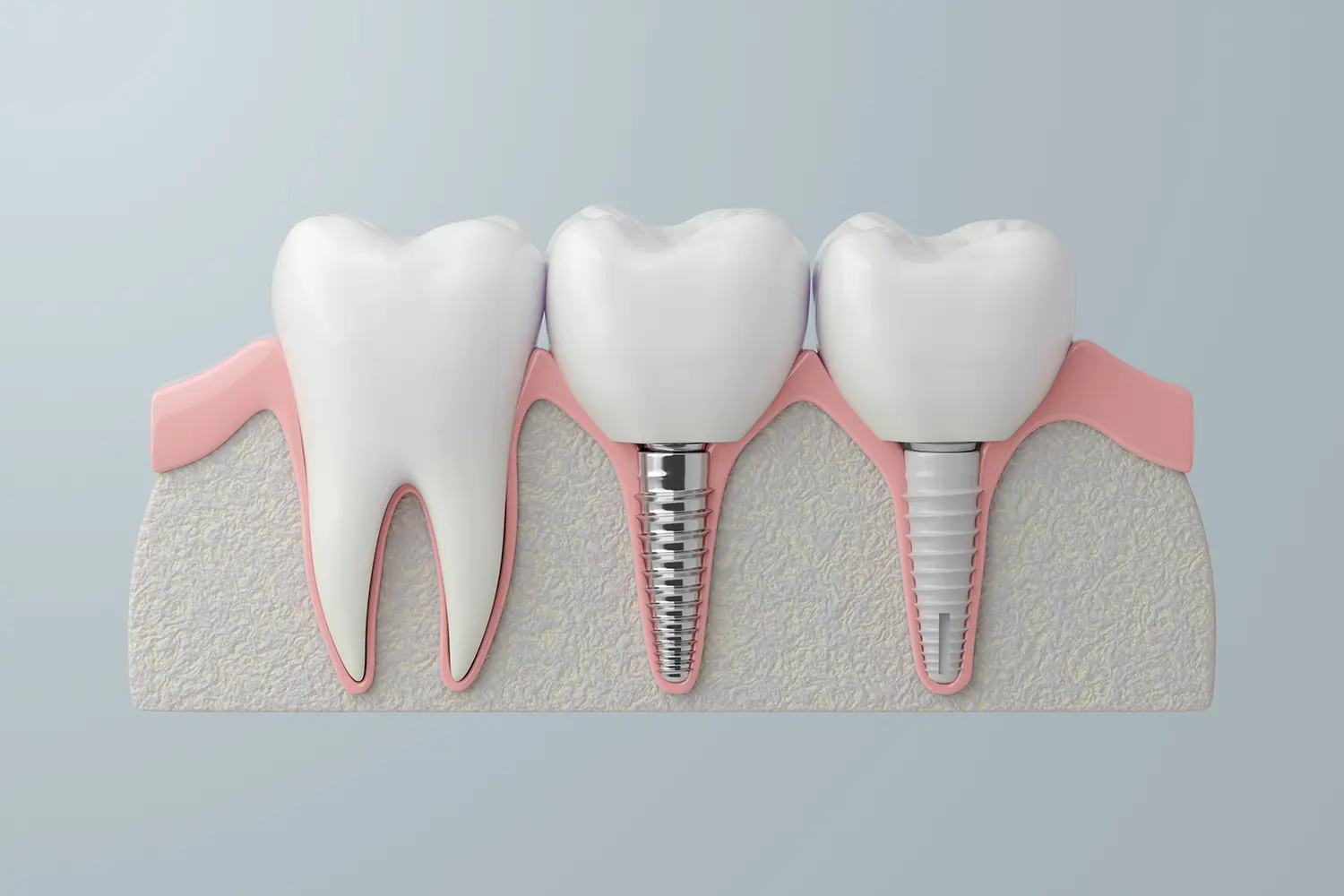 Dental Implants in Gulf Breeze, FL | Pearl and Pine Dental Studio