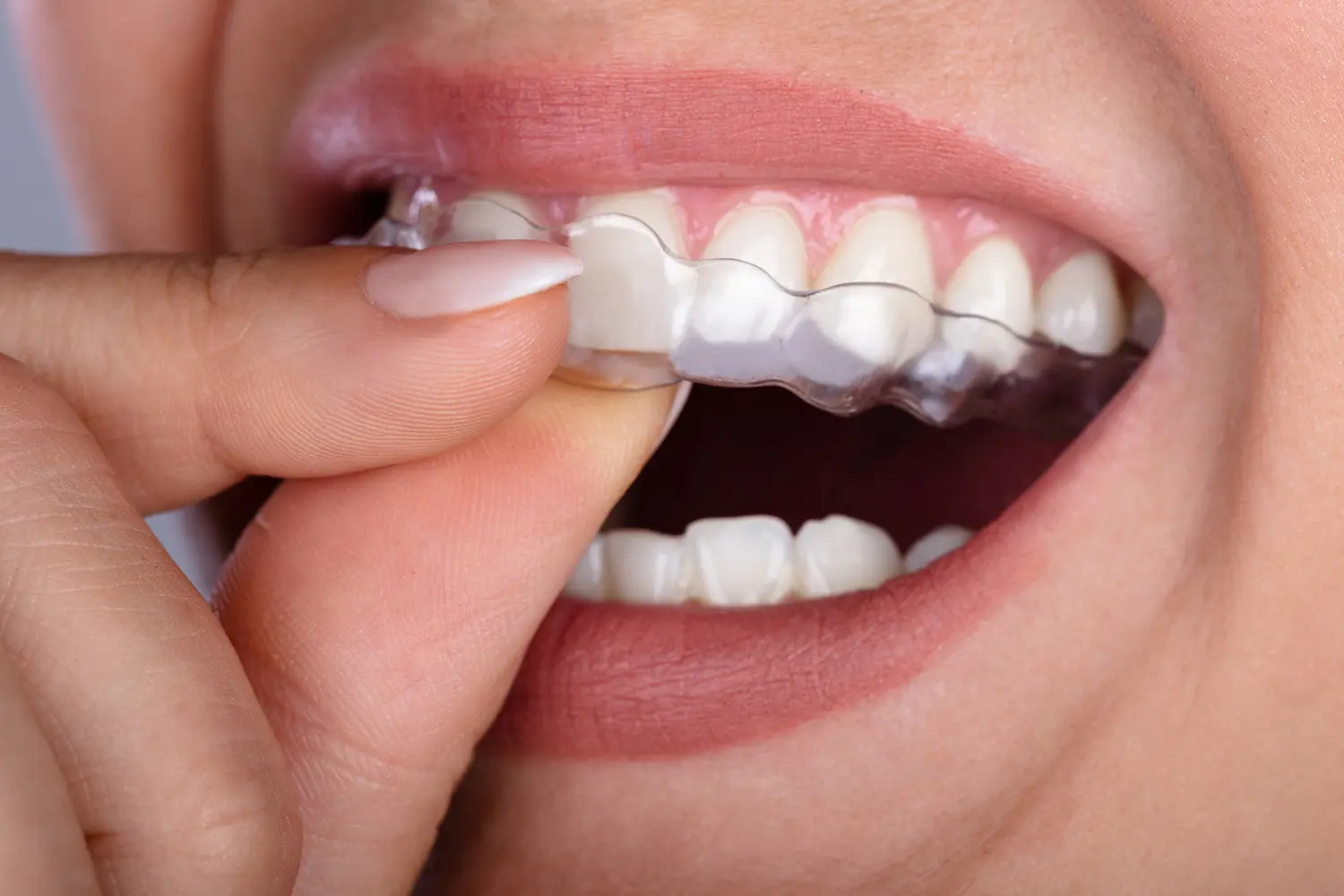 Orthodontic Services in Gulf Breeze, FL | Pearl and Pine Dental Studio