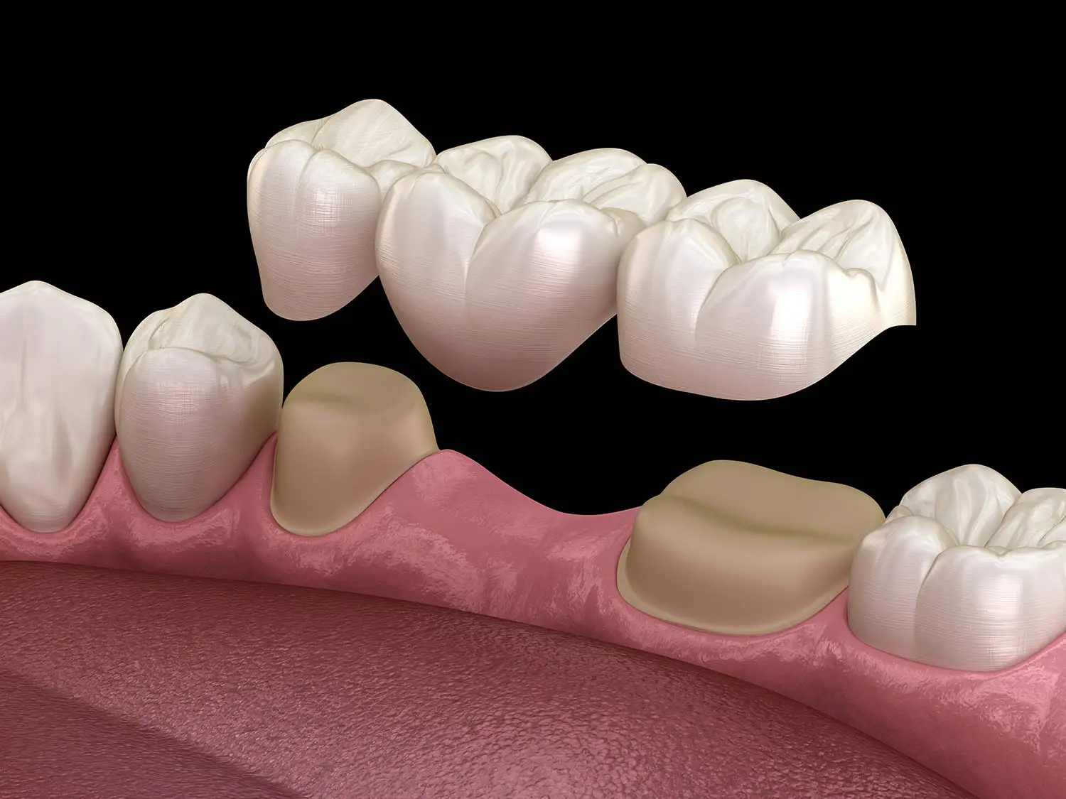 Dental Crowns & Bridge in Gulf Breeze, FL | Pearl and Pine Dental Studio