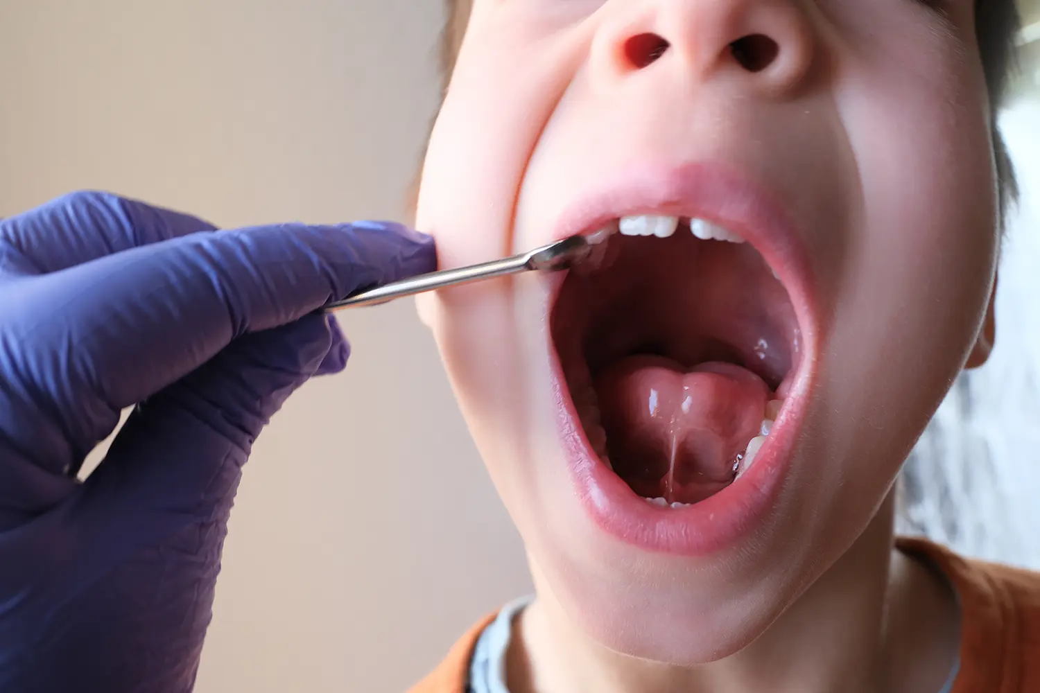 LightScalpel Laser Treatment in Gulf Breeze, FL | Pearl and Pine Dental Studio