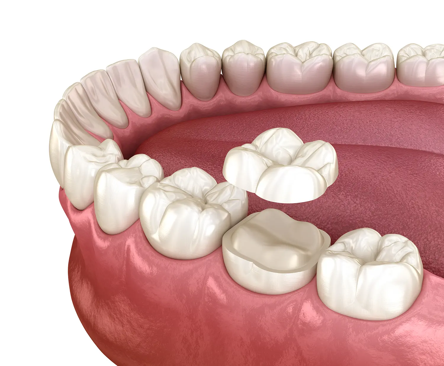 Biomimetic Onlays in Gulf Breeze, FL | Pearl and Pine Dental Studio