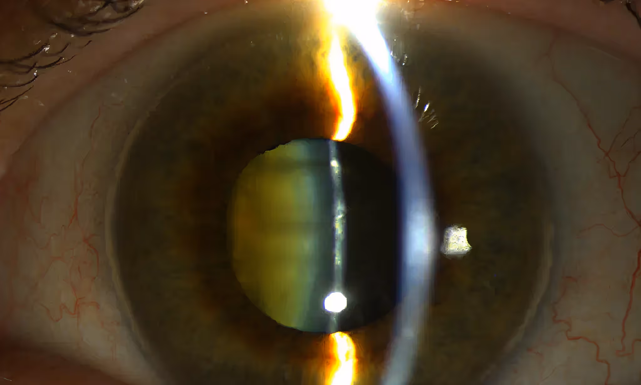 Close-up of a human eye showing the iris, pupil, and reflections of medical equipment light beams.