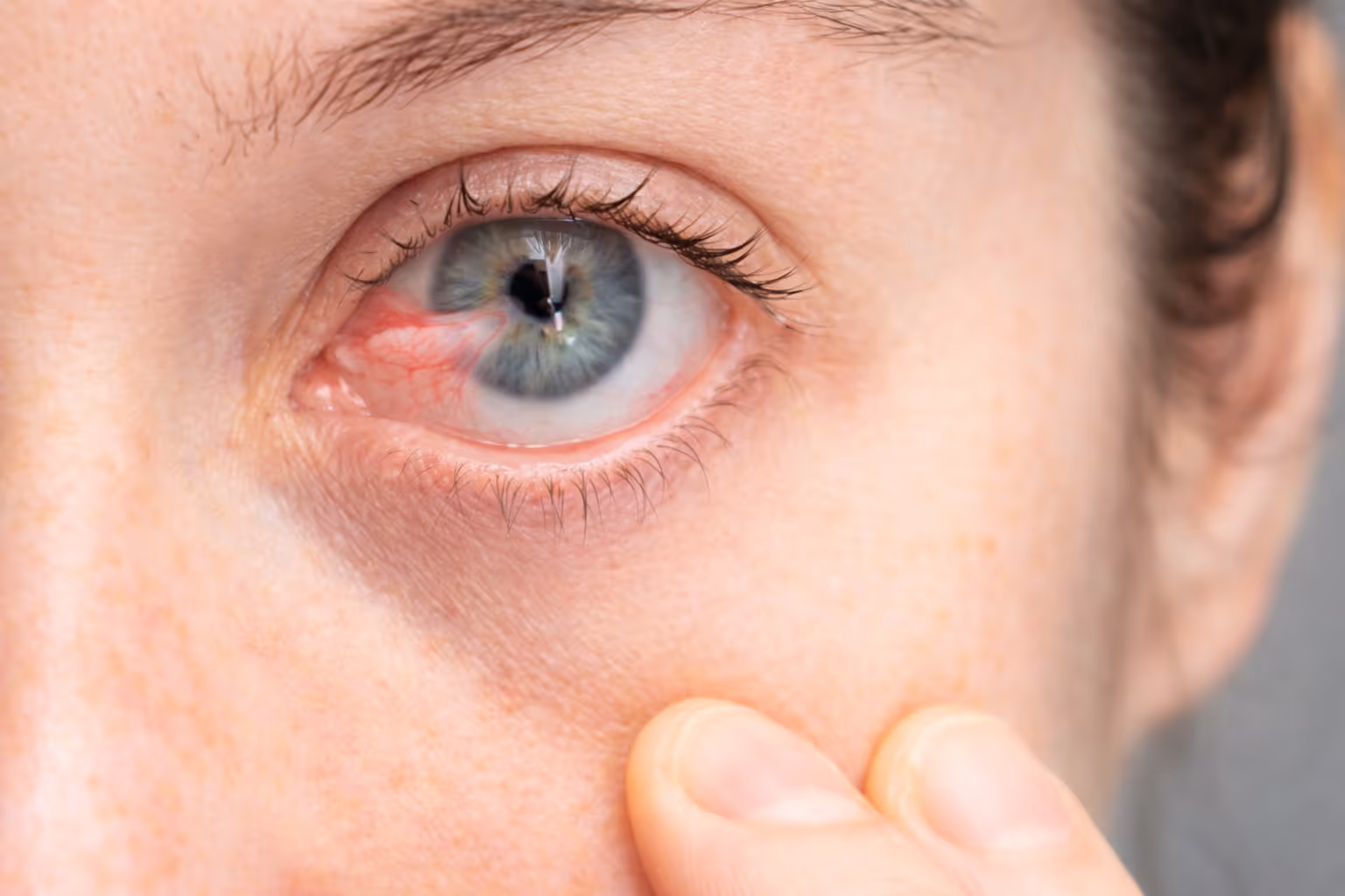 Close-up of a human eye with visible redness and blood vessels, with fingers gently touching the cheek.