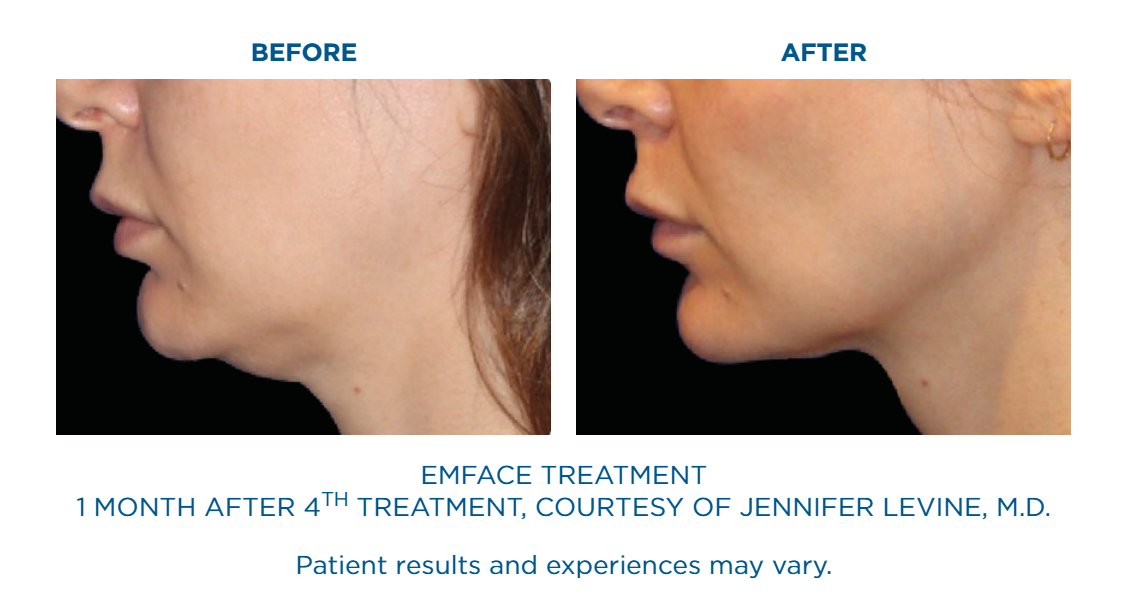 Side-by-side before and after images showing improved jawline and reduced double chin one month after the fourth EMFACE treatment.