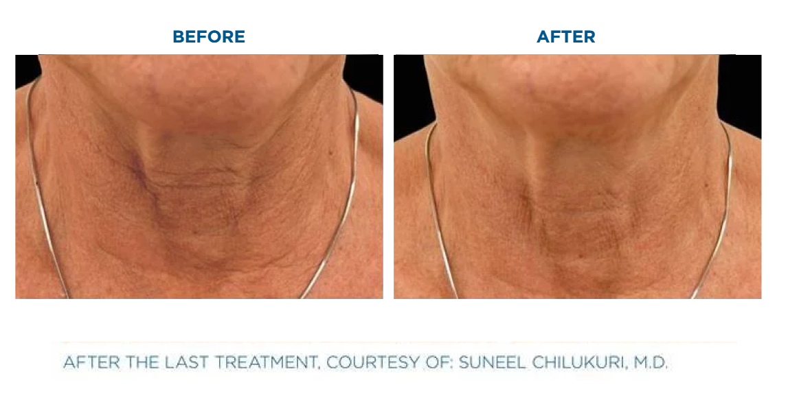 Side-by-side comparison of a neck showing reduced wrinkles and smoother skin after treatment.