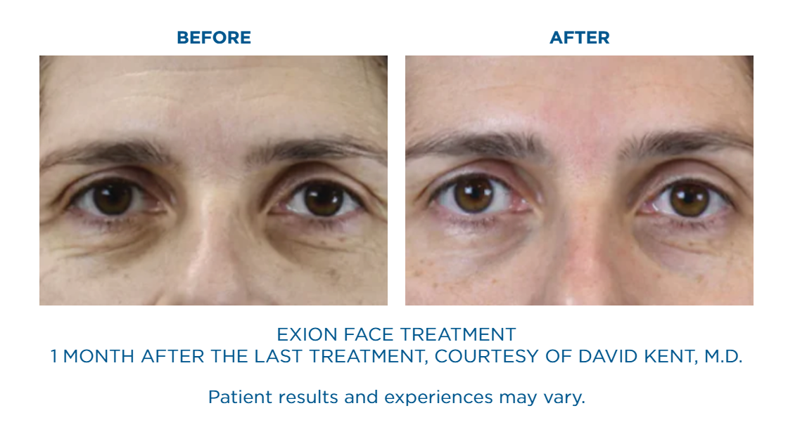 Close-up comparison of a person's eyes before and one month after Exion Face Treatment showing reduced under-eye wrinkles and smoother skin.