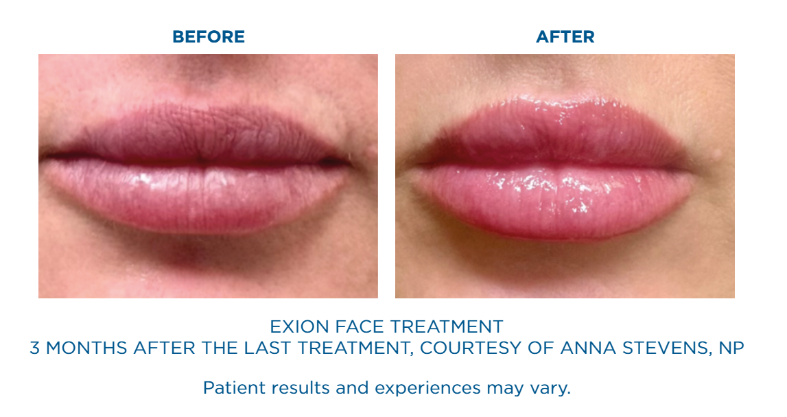 Side-by-side before and after close-up images of lips showing fuller, shinier lips after Exion Face treatment.