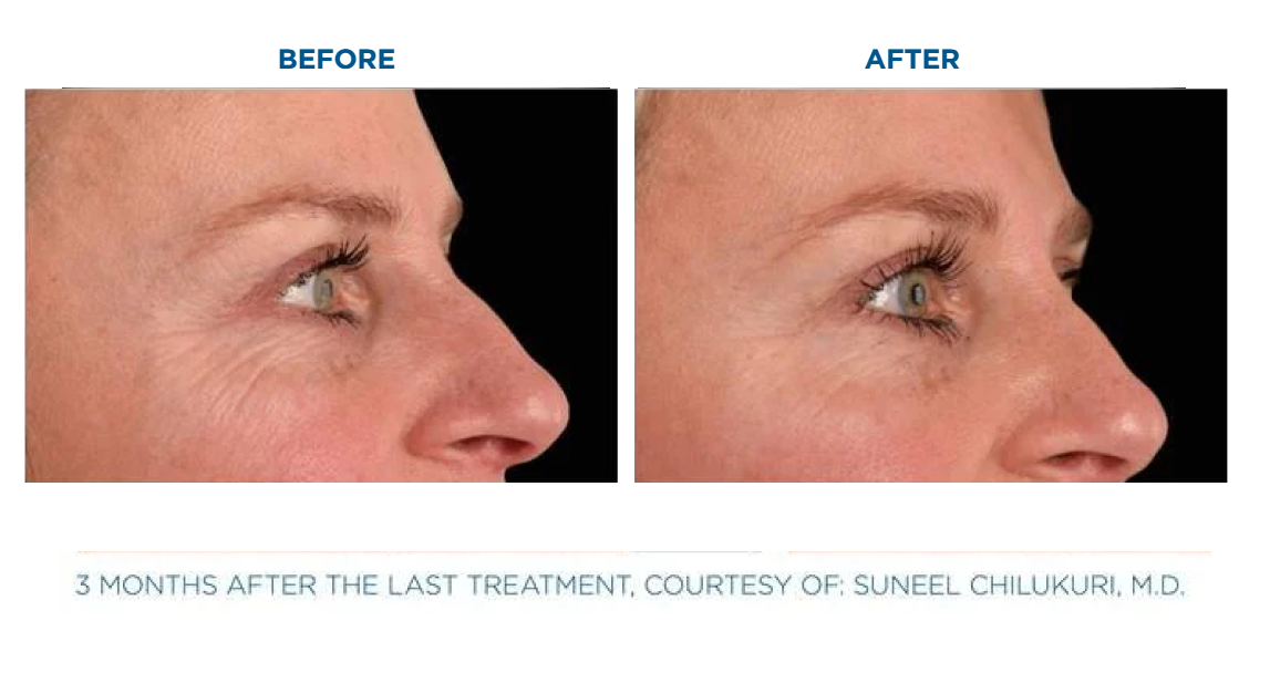 Side-by-side profile close-ups of a woman's face showing reduction of wrinkles around the eye area after treatment.