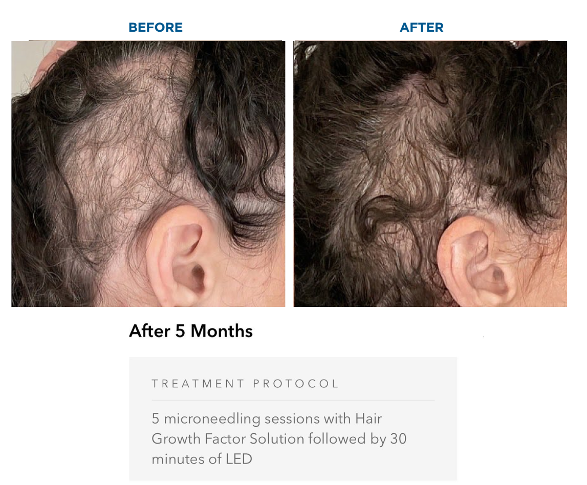 Side-by-side comparison of a person's scalp before and after hair treatment showing increased hair density after five months of microneedling and LED therapy.