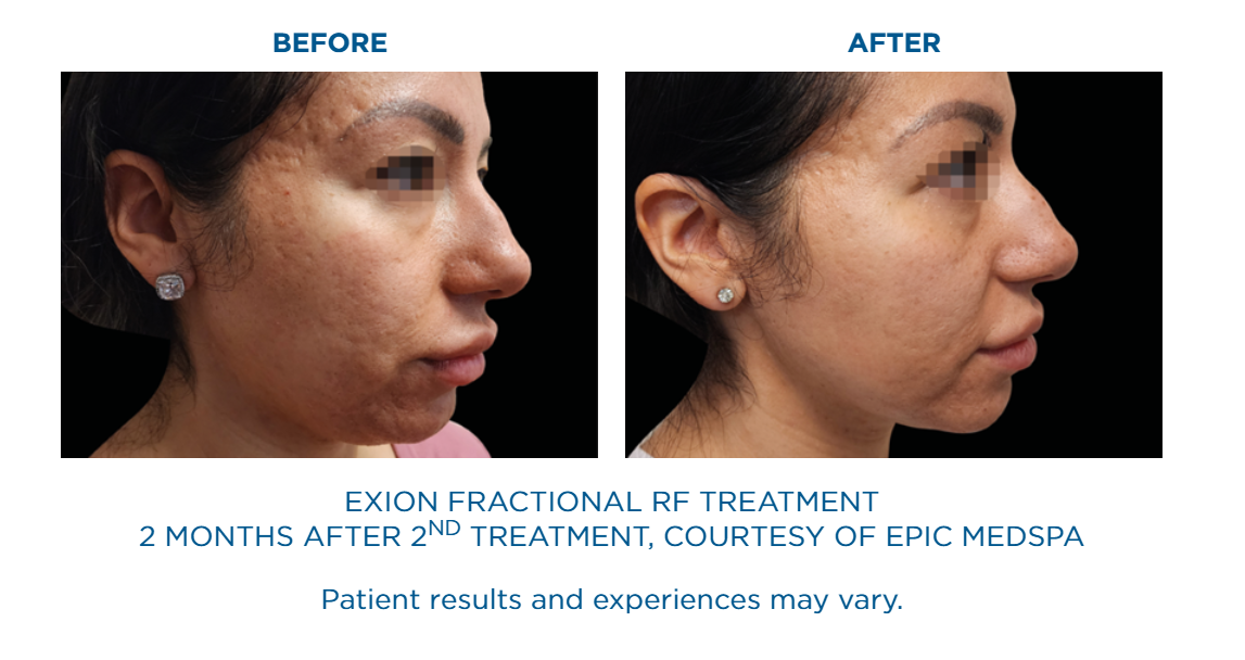 Side-by-side comparison of a woman's face before and after Exion Fractional RF treatment showing smoother skin two months after the second session.