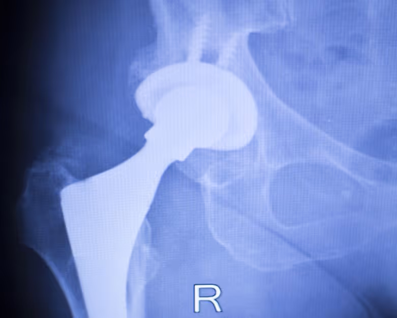 hip replacement