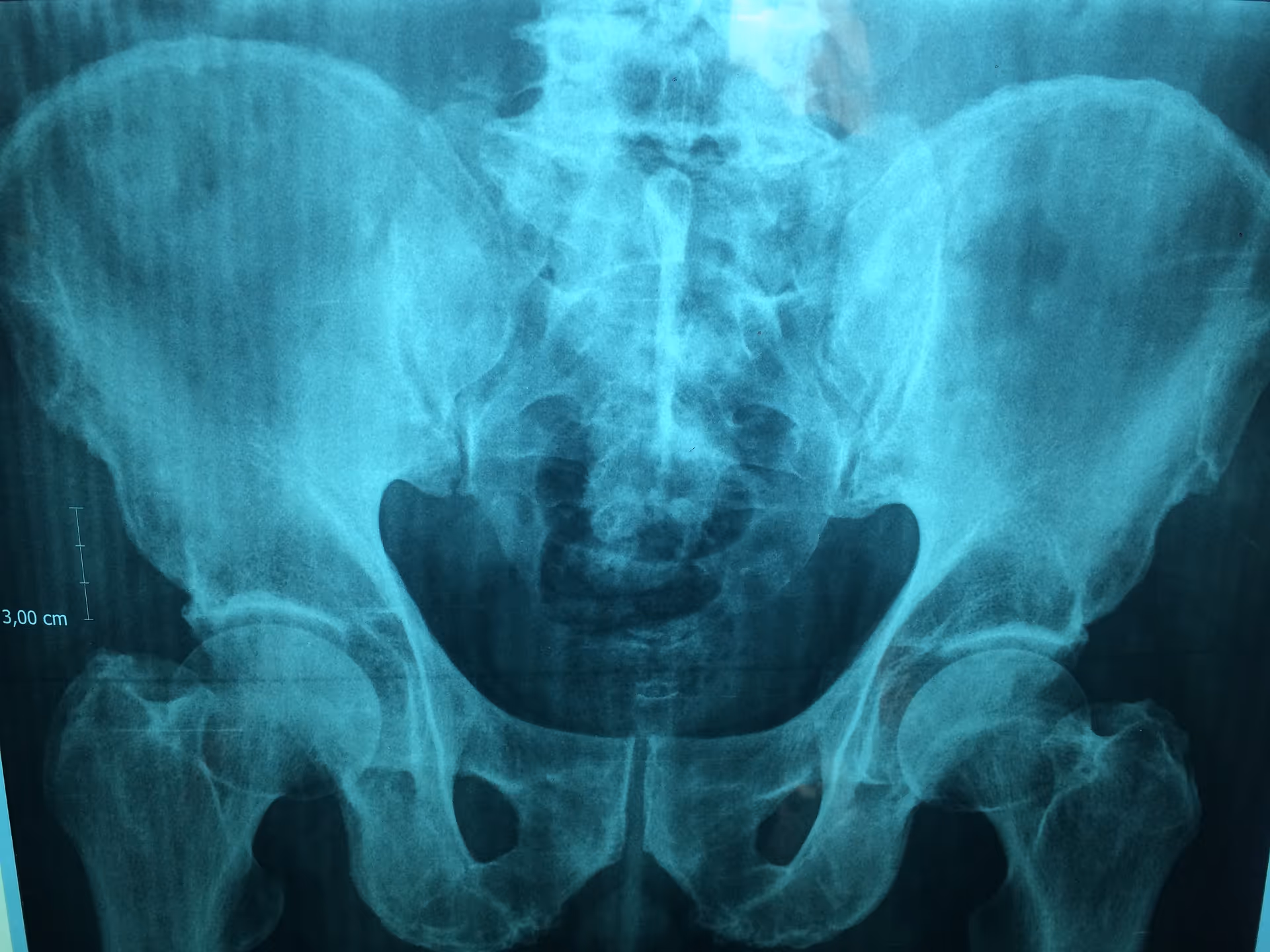 hip x ray