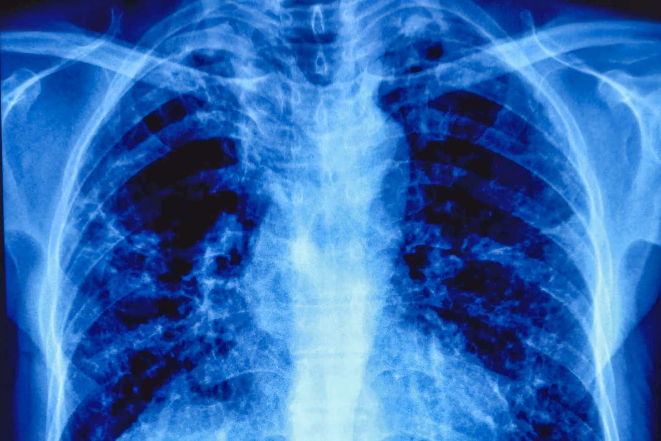 X-ray image of human lungs, representing the health impact of asbestos exposure and the role of an Indiana Mesothelioma Lawyer in seeking justice for victims.