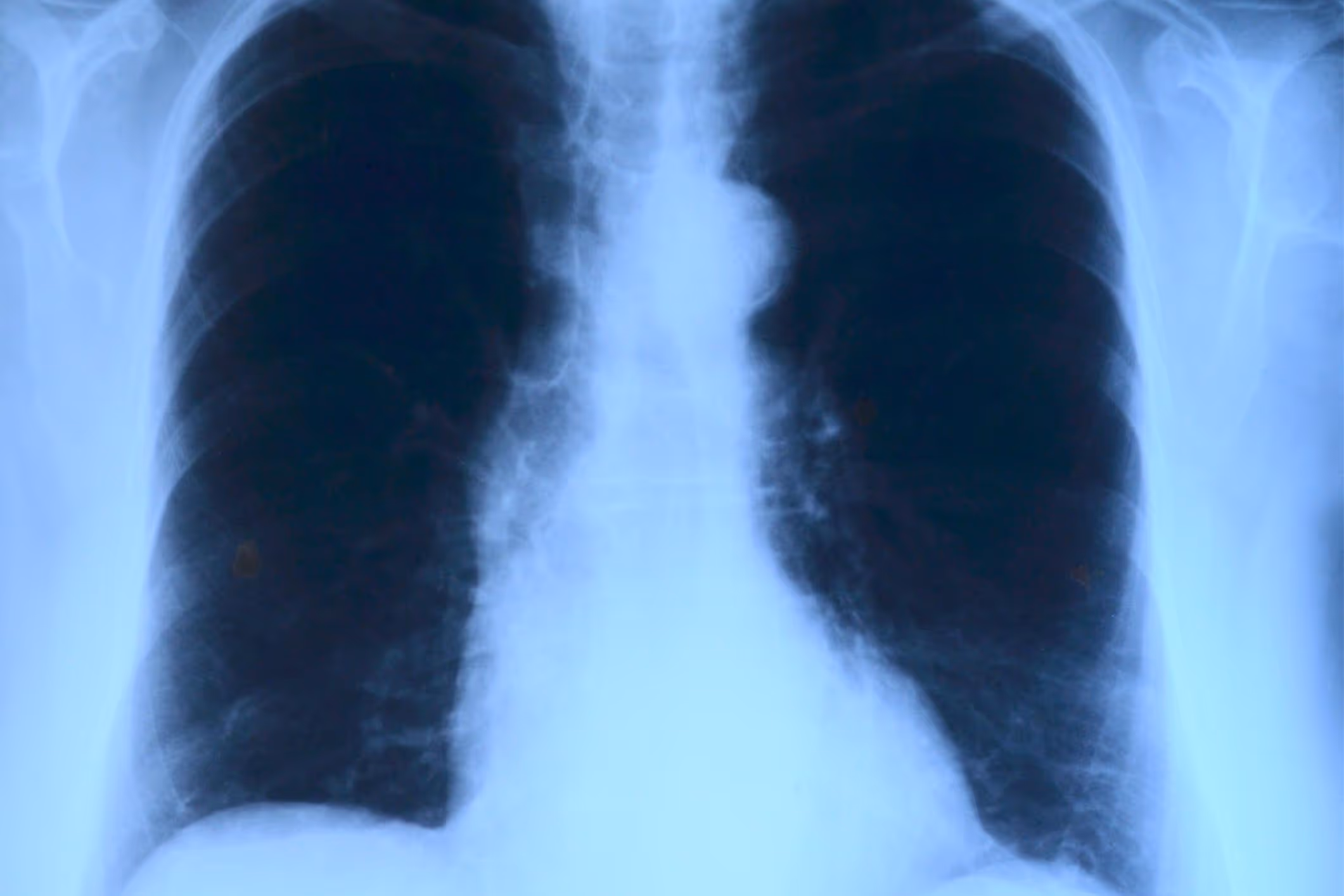 lung x ray