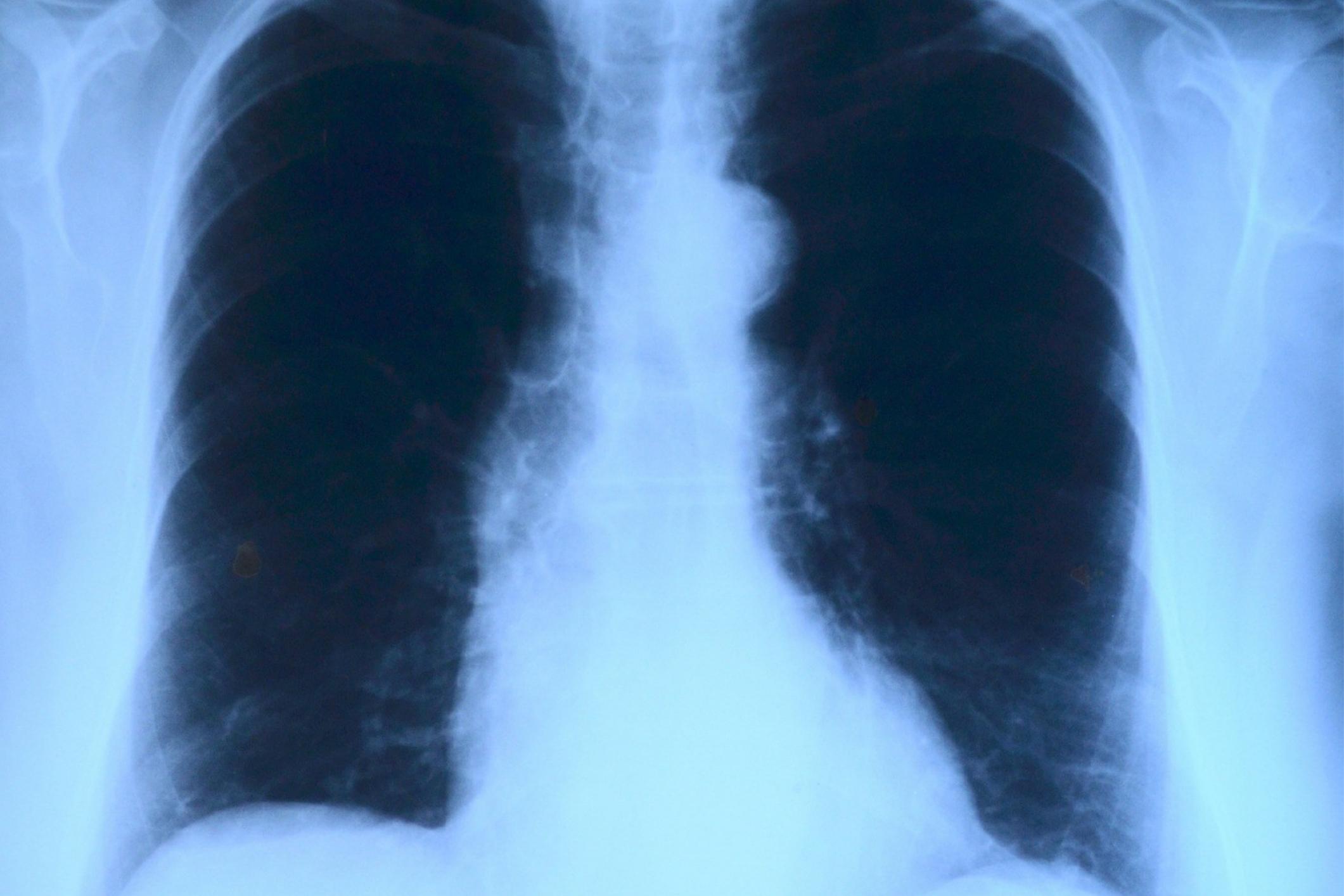 lung x ray