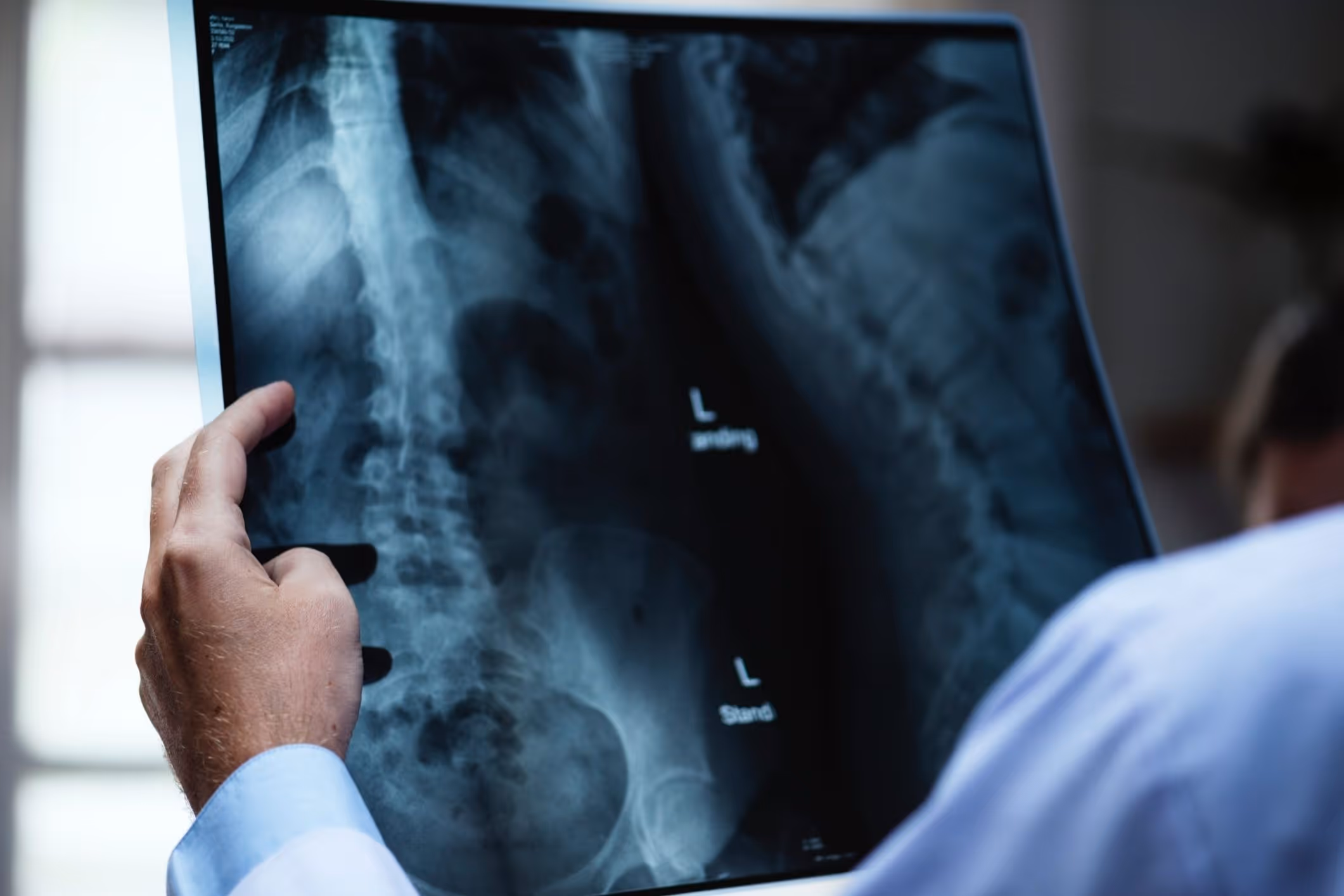 Mesothelioma Cancer
