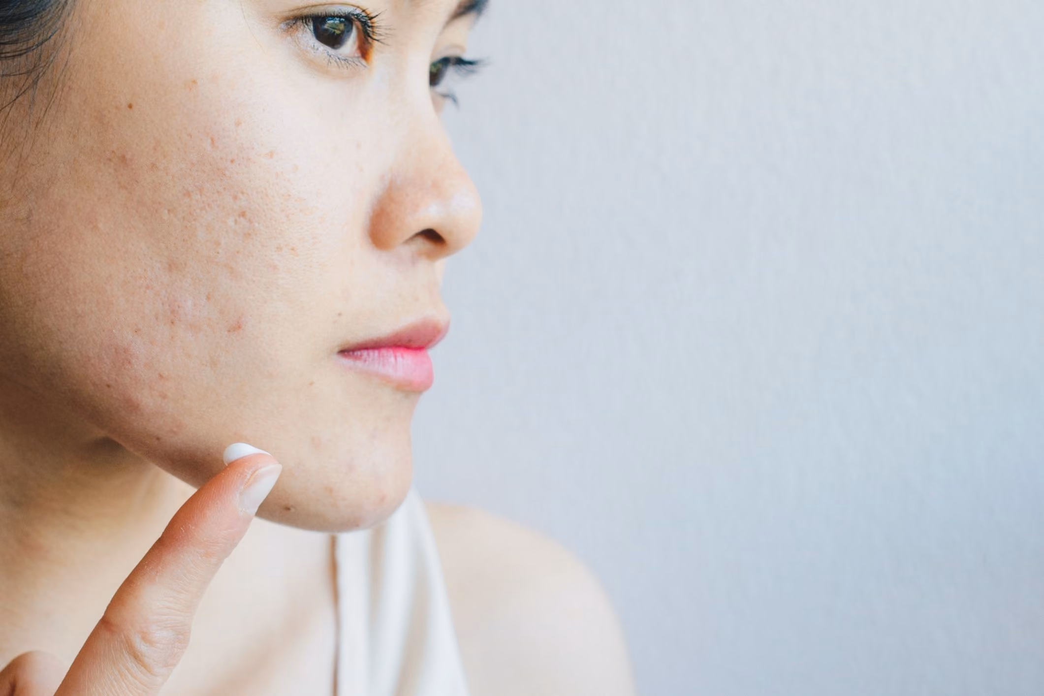 Recent studies found benzene in acne products, sparking recalls and lawsuits. Learn about your legal options if your skincare routine is putting you at risk.