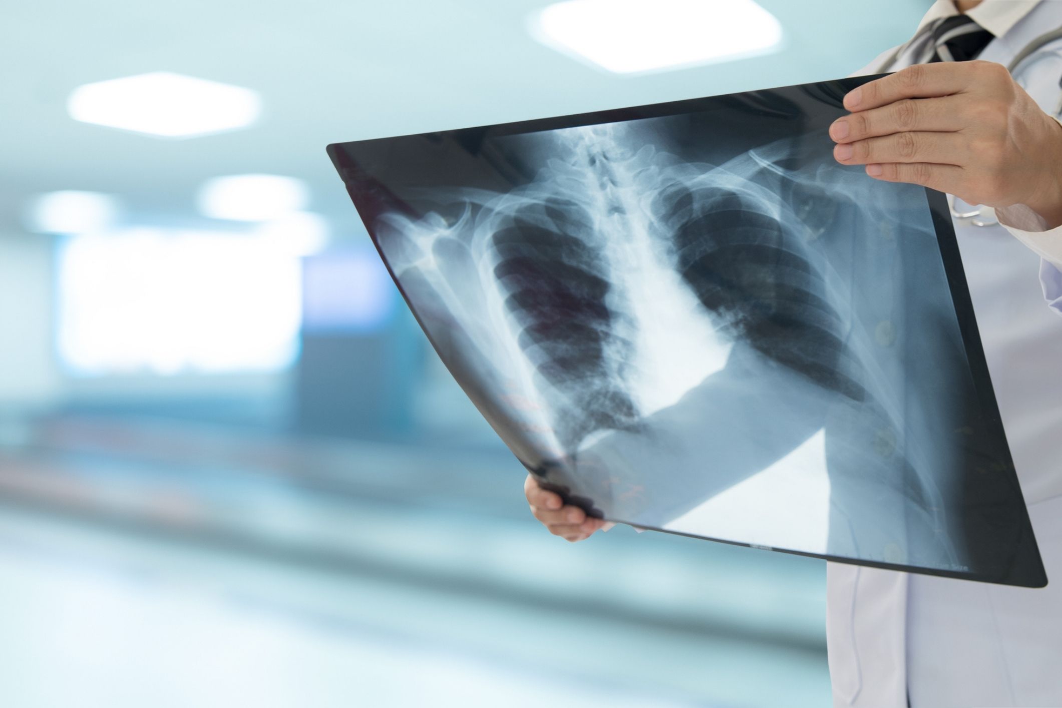 A doctor checks a lung scan. A crucial piece of evidence in a popcorn lung lawsuit.