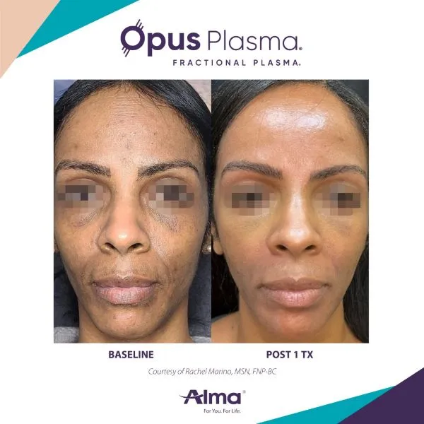 Opus Plasma skin resurfacing before and after results at Mantra Health and Wellness in Modesto, CA