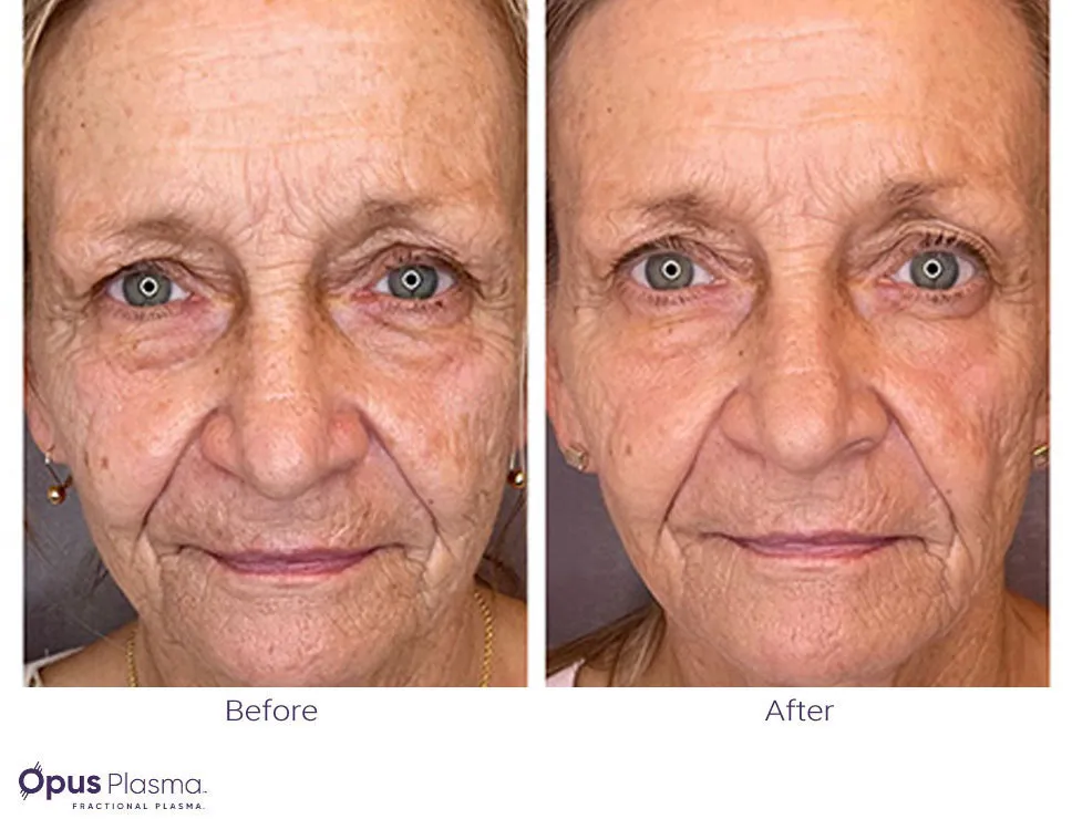 Opus Plasma skin resurfacing before and after results at Mantra Health and Wellness in Modesto, CA
